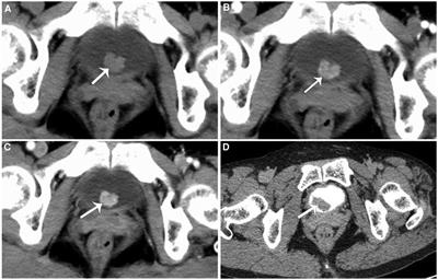 Malacoplakia of the bladder combined with infected renal calculi: A case report